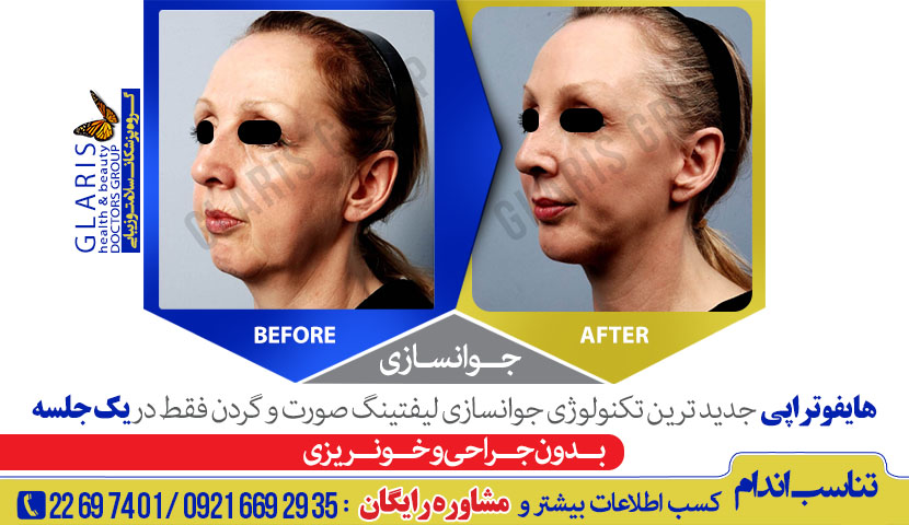 جوانسازی