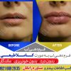 تزریق ژل لب