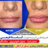 تزریق ژل لب