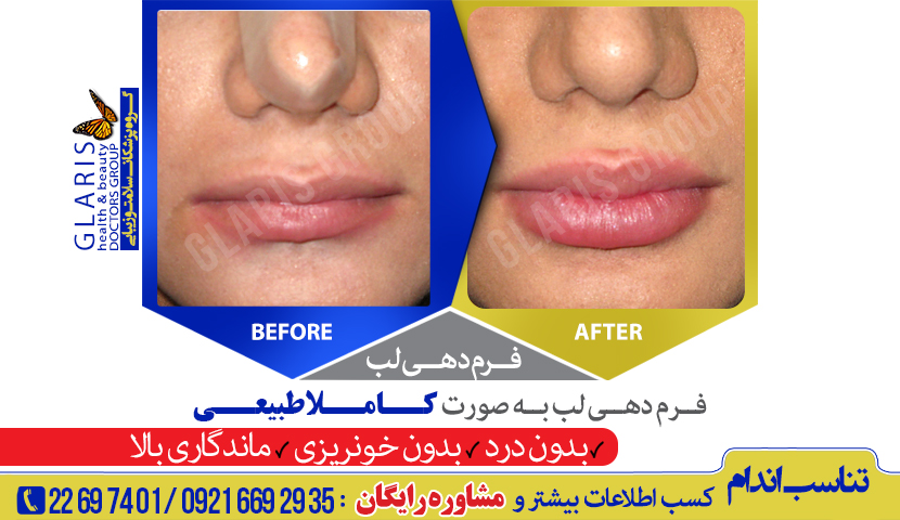 تزریق ژل لب