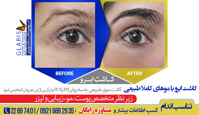 کاشت ابرو طبیعی