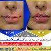 تزریق ژل لب