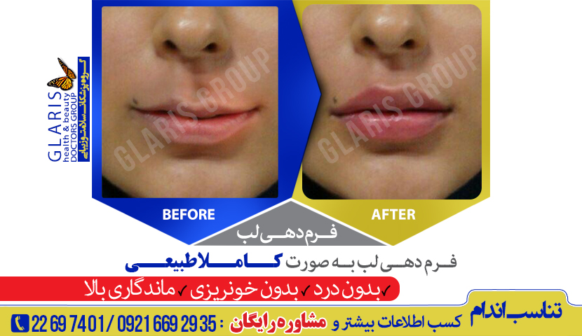 تزریق ژل لب