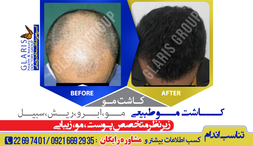 کاشت مو طبیعی